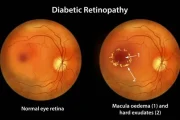 Automated Detection of Macular Edema